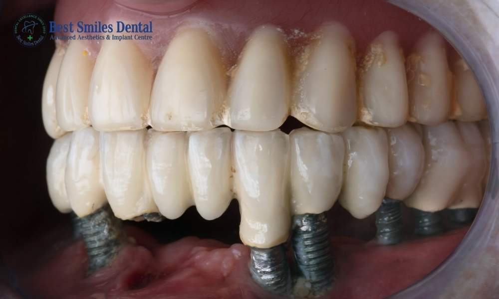 Full Mouth Dental Implant