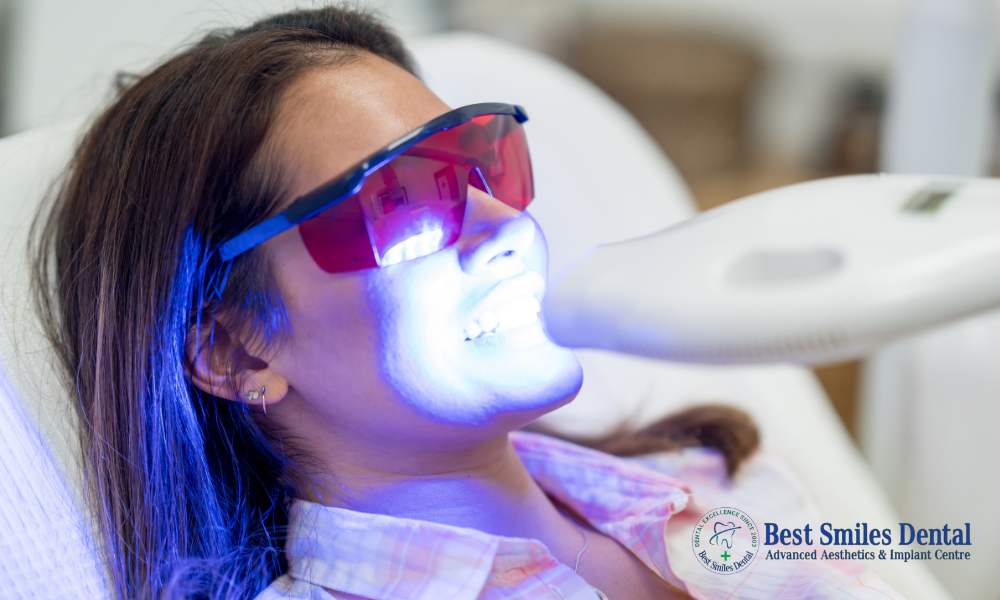 Laser Teeth Whitening