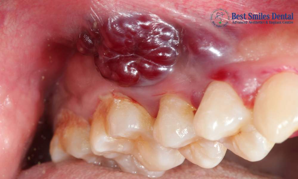 Oral Cancer Screening