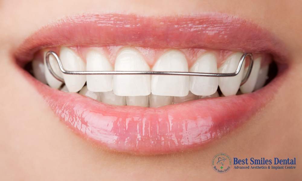 Retainers for Teeth Alignment