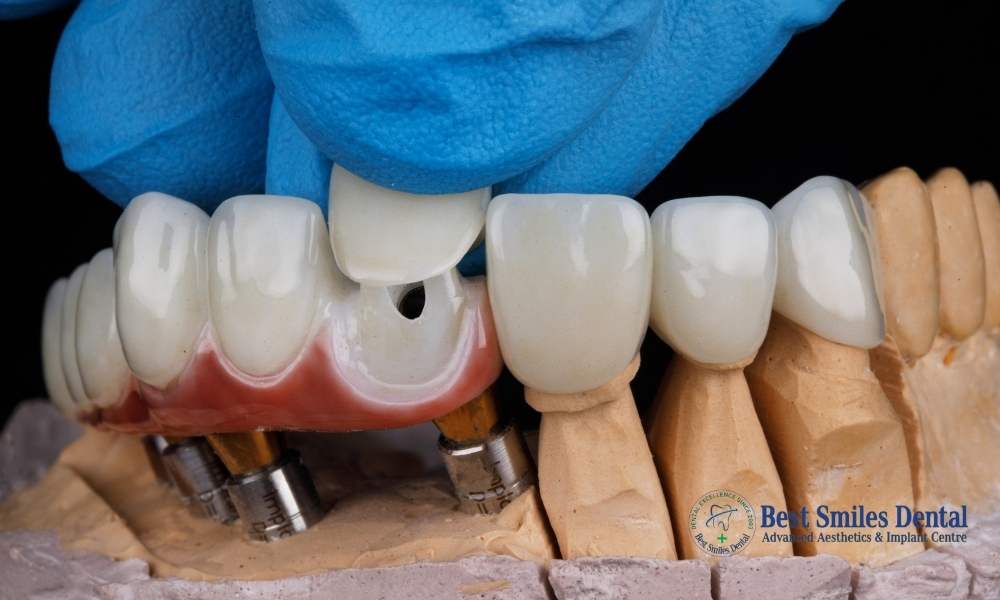 Smile Makeover with Crowns and Veneers