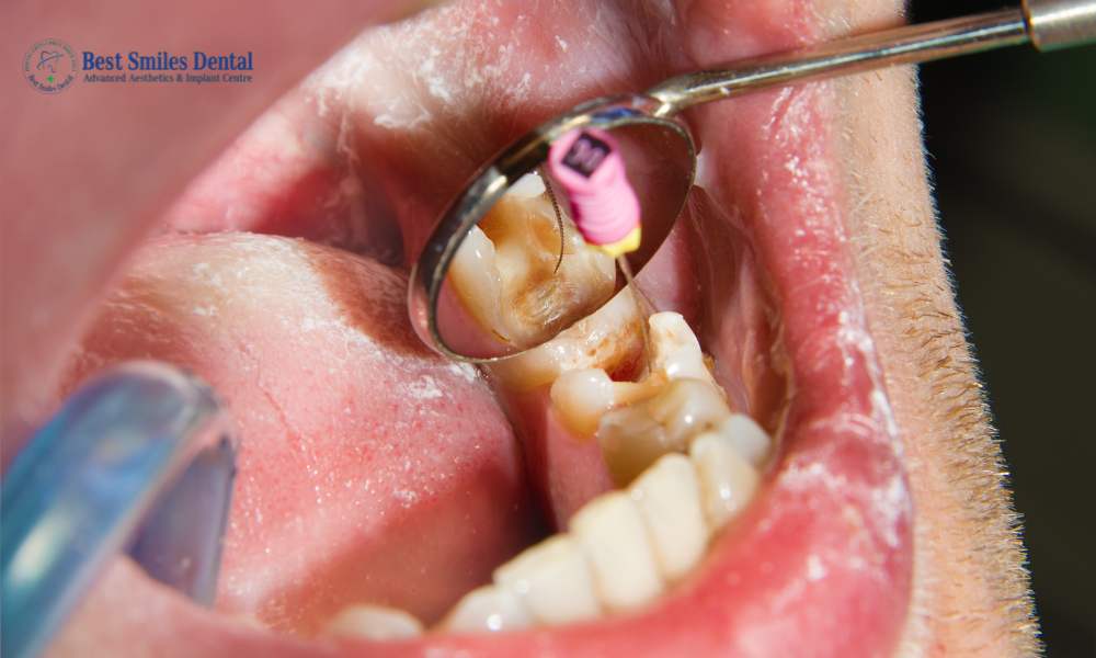 failed Root Canal Treatment